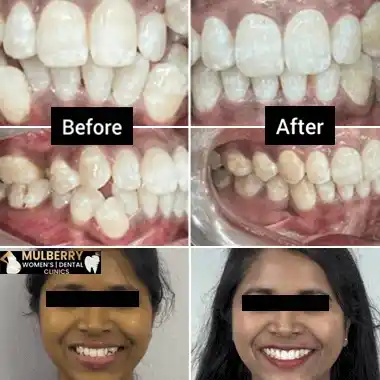 Before After Images