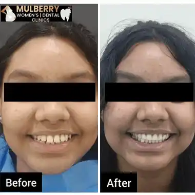 Before After Images