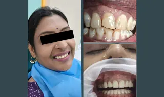 Dental Veneers