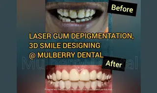 Gum Treatment