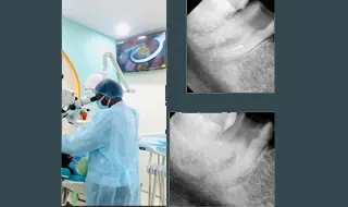 Microscopic Laser Root Canal